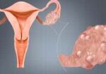 Polycystic-Ovaries-Syndrome