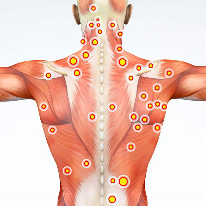 Trigger-Points-CROPPED-1024x706-1